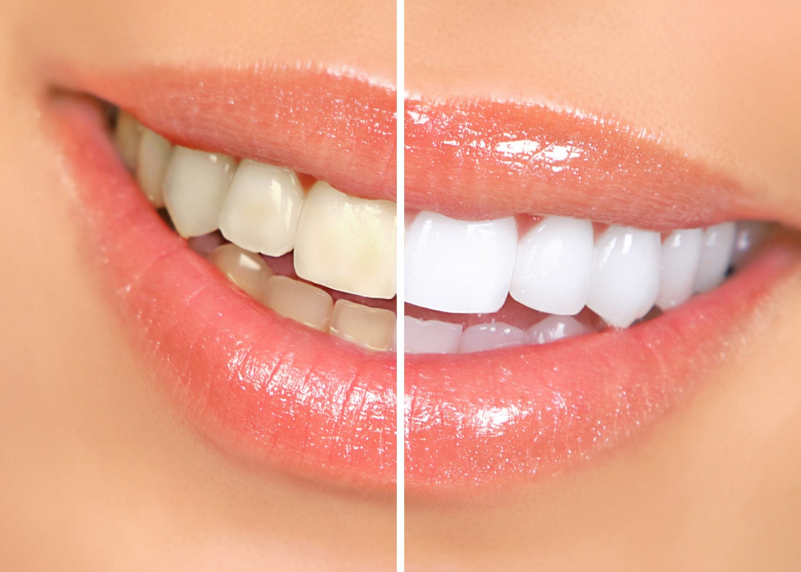 teethwhitening1-1-scaled.jpg