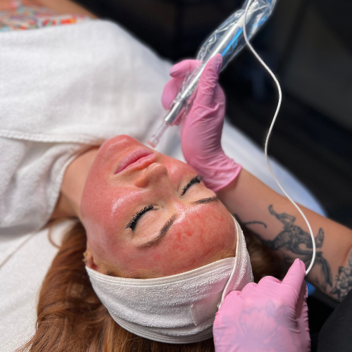Microneedling