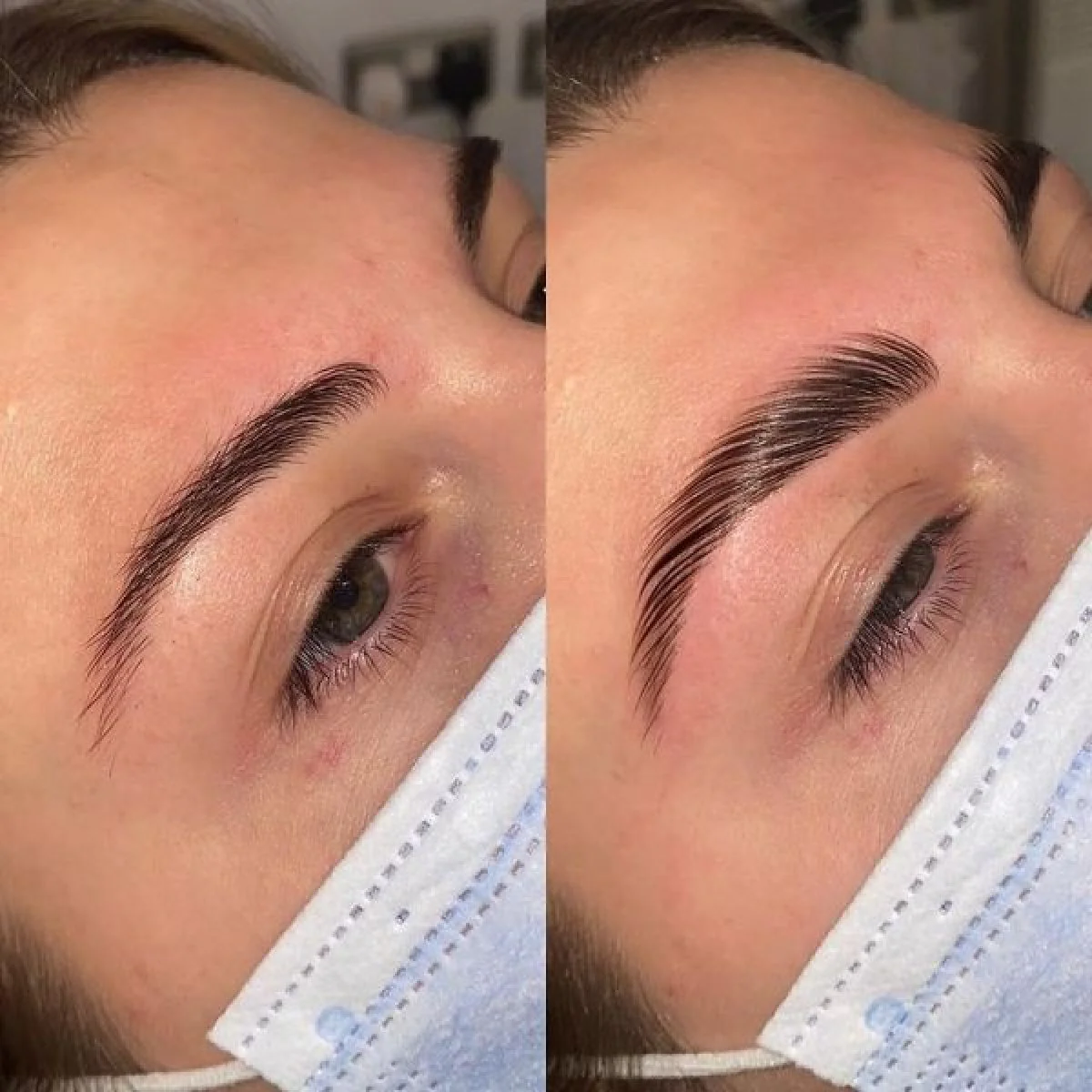 Brow Lift