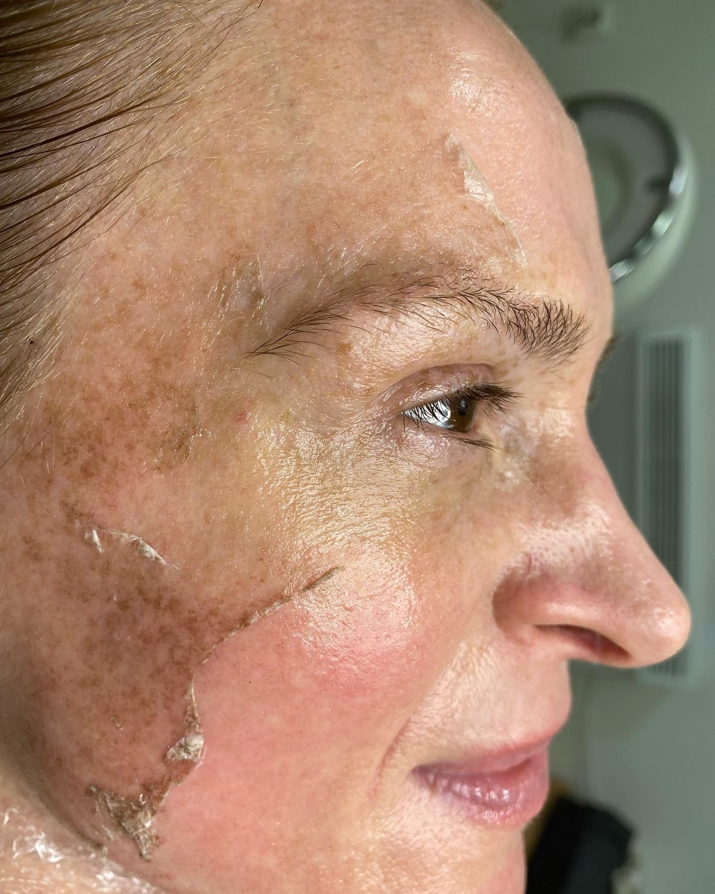 Peeling