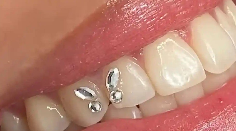Strass Dentaire